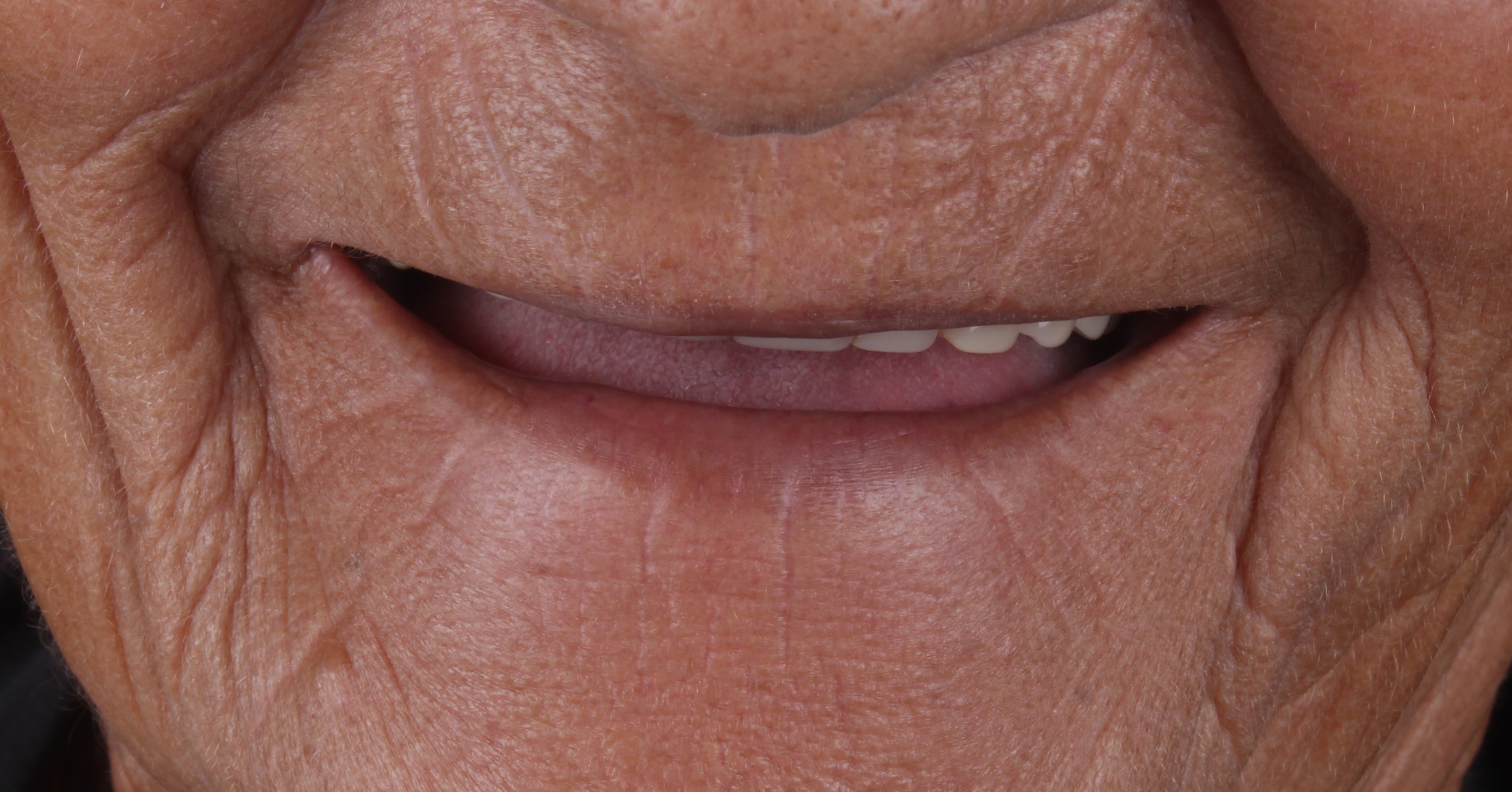 Antes da prótese total